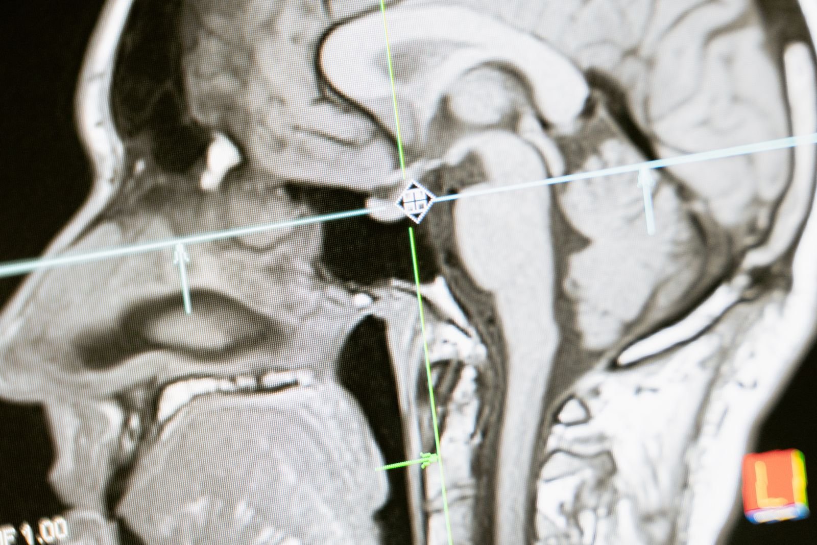 Clinical brain MRI scan used in Cody A. Moxam neuromodulation research